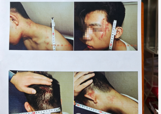 运城17岁男生遭假警察骗出门殴打，被诊断抑郁