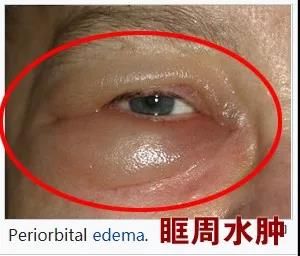 眼睑,眼周围部分皮肤炎症感染会造成眼眶周围蜂窝组织炎,形成眶周水肿